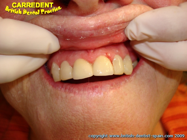 crowns fillings 2 decayed teeth